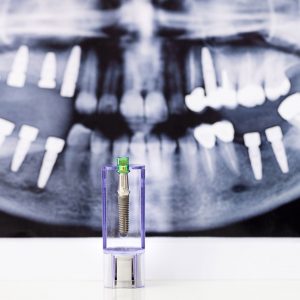 Implantes-dentales